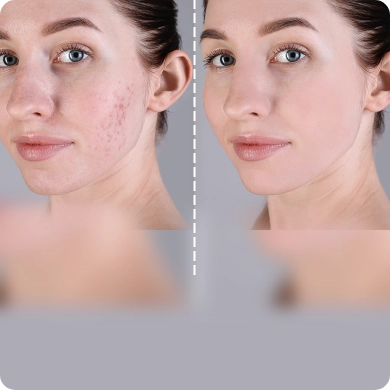Acne and Blemish Removal