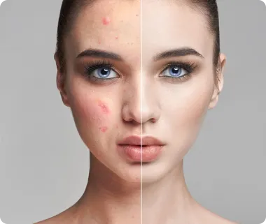 Acne and blemish removal
